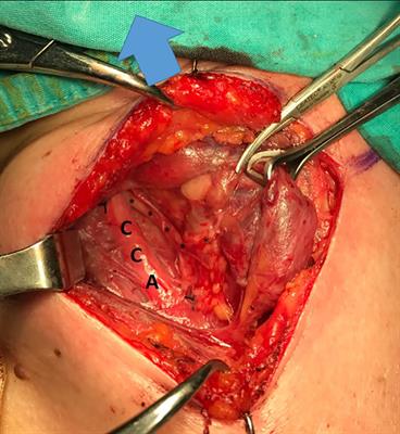 Electrophysiological monitoring of the nonrecurrent inferior laryngeal nerve and radiological evaluation of concurrent vascular anomalies